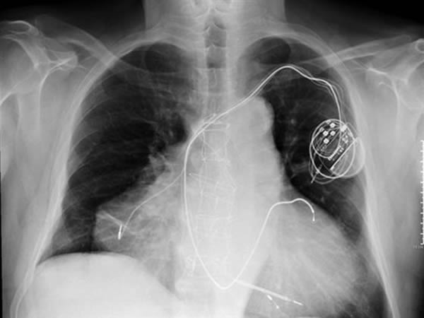 a98828_extra-body_6-transplanted-heart