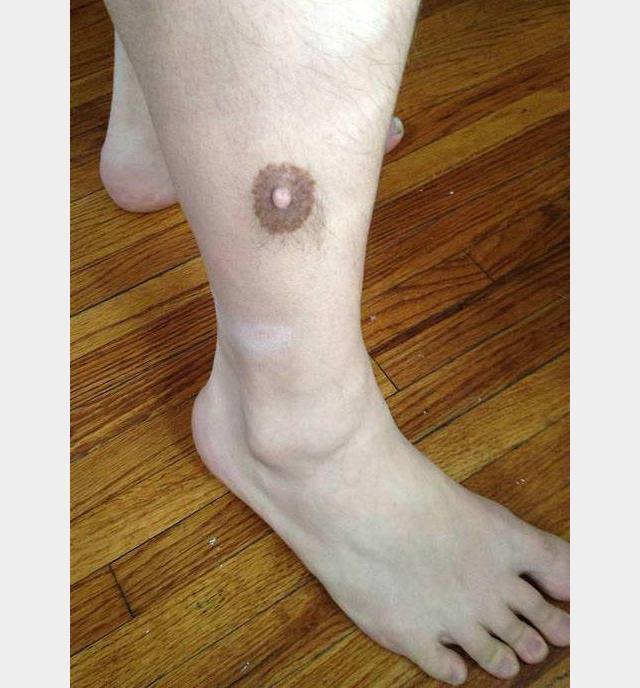 nipple on leg